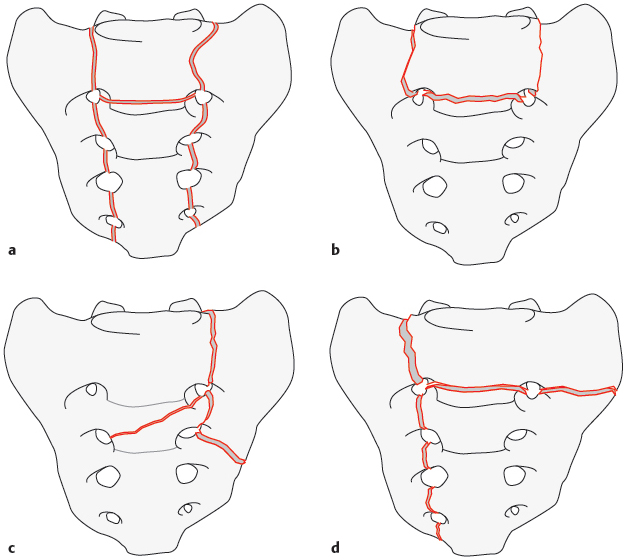 1.10 Lumbosacral Instability And Stabilization | Musculoskeletal Key