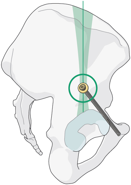 2.10.3 Surgical Management Of B Types: B1, B2, B3 | Musculoskeletal Key