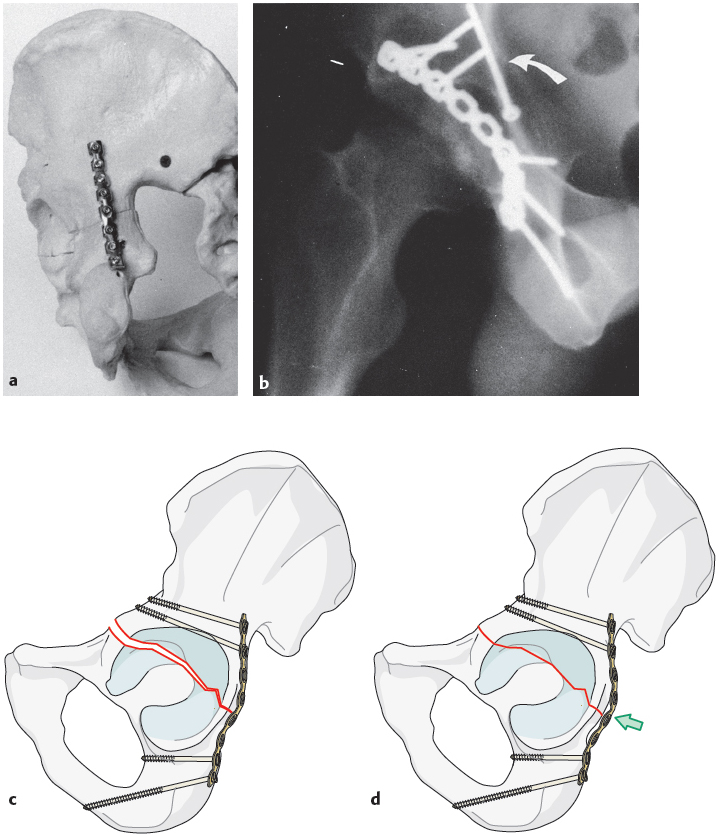 2.10.3 Surgical Management Of B Types: B1, B2, B3 | Musculoskeletal Key