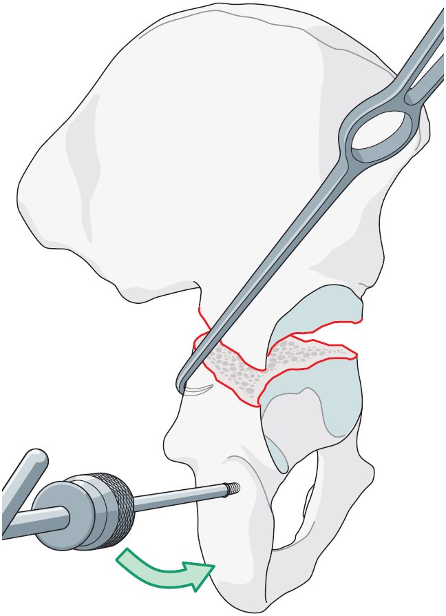 2.10.3 Surgical Management Of B Types: B1, B2, B3 | Musculoskeletal Key