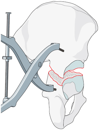 2.10.3 Surgical Management Of B Types: B1, B2, B3 | Musculoskeletal Key