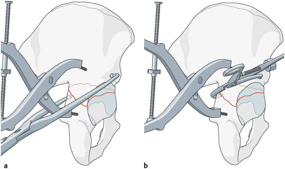 2.10.3 Surgical Management Of B Types: B1, B2, B3 | Musculoskeletal Key