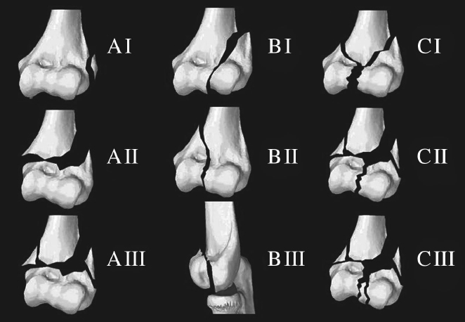 Distal Humeral Fractures | Musculoskeletal Key