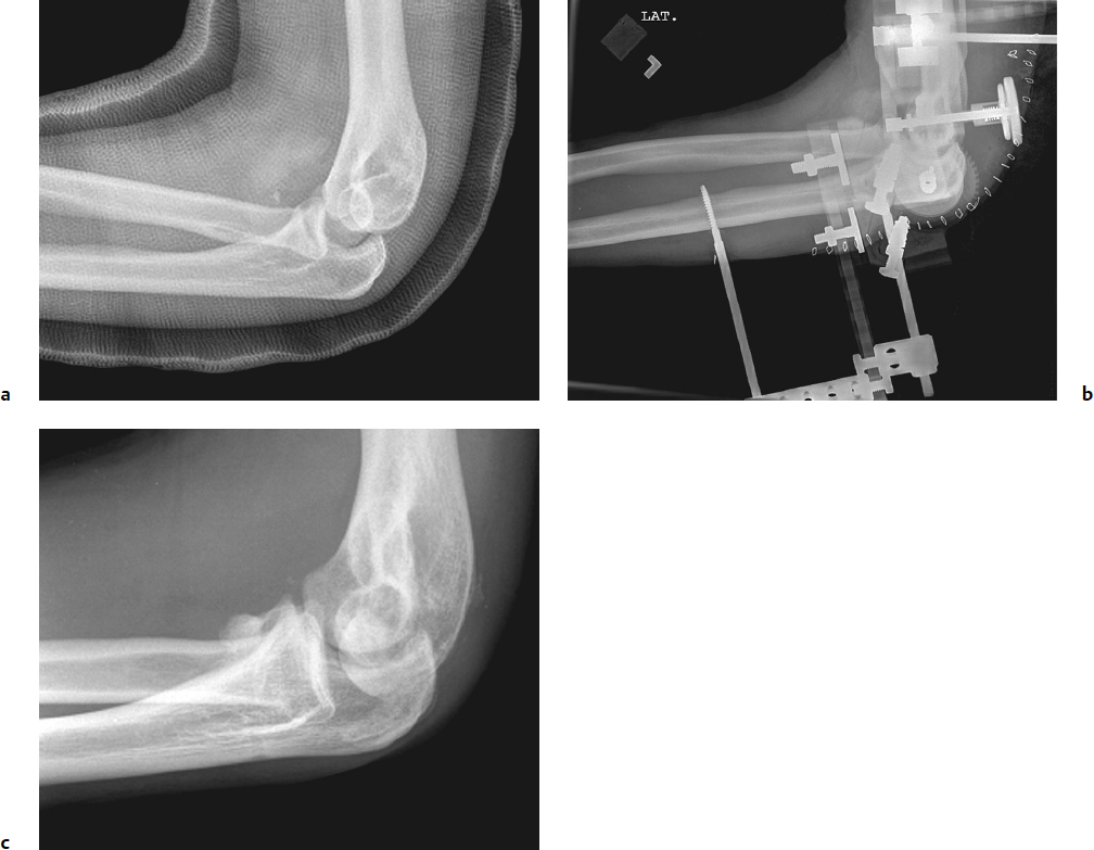 Elbow Trauma | Musculoskeletal Key