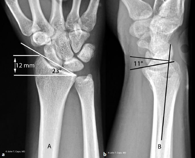 Distal Radius Fracture