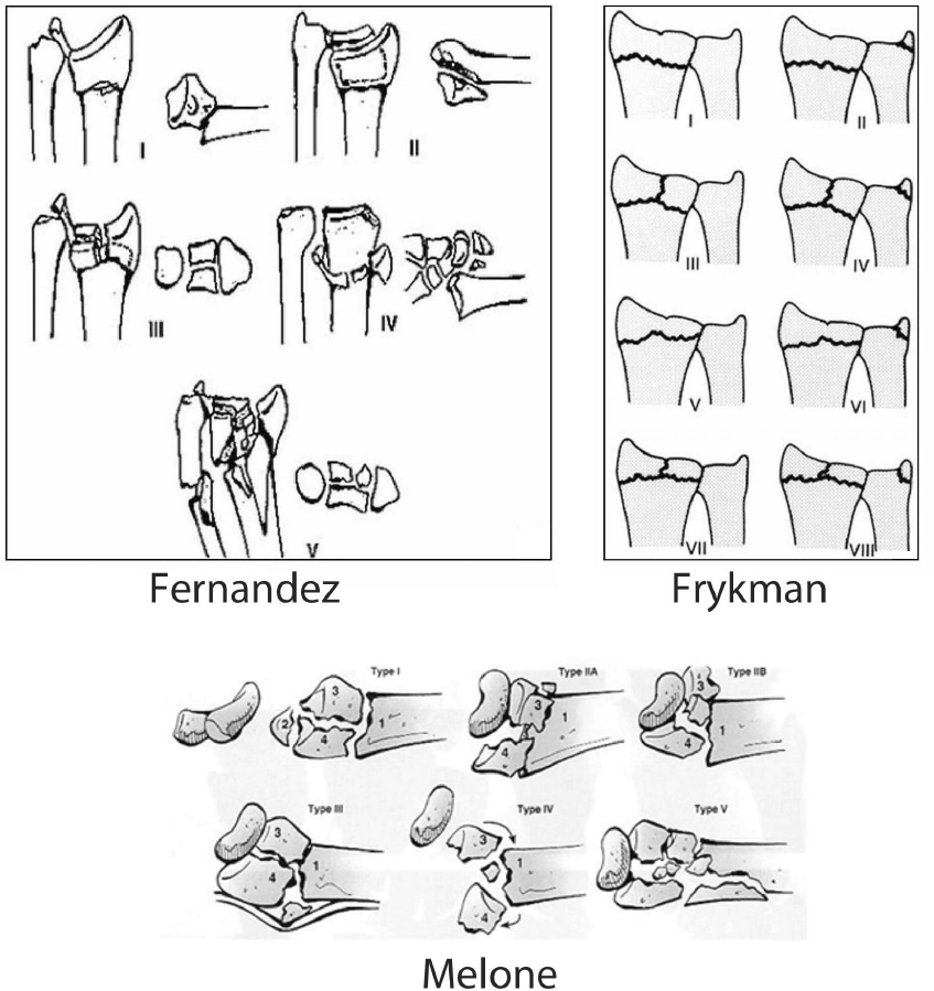 Distal Radius Fractures Trauma Orthobullets | Atelier-yuwa.ciao.jp