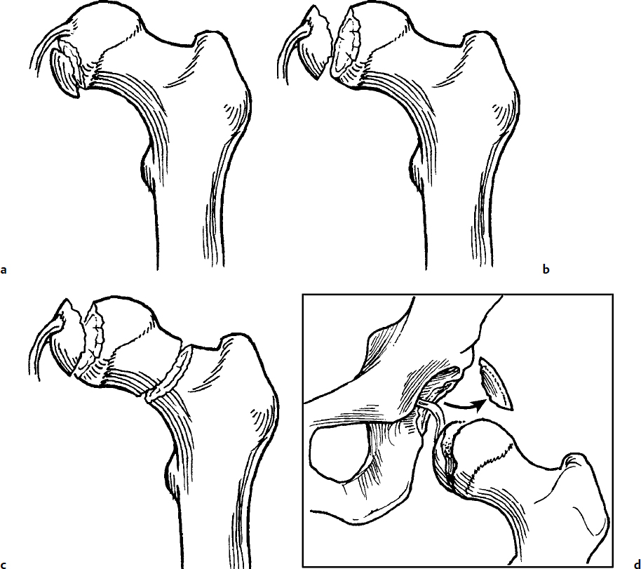 Hip Dislocations And Associated Fractures Of The Femoral Head ...