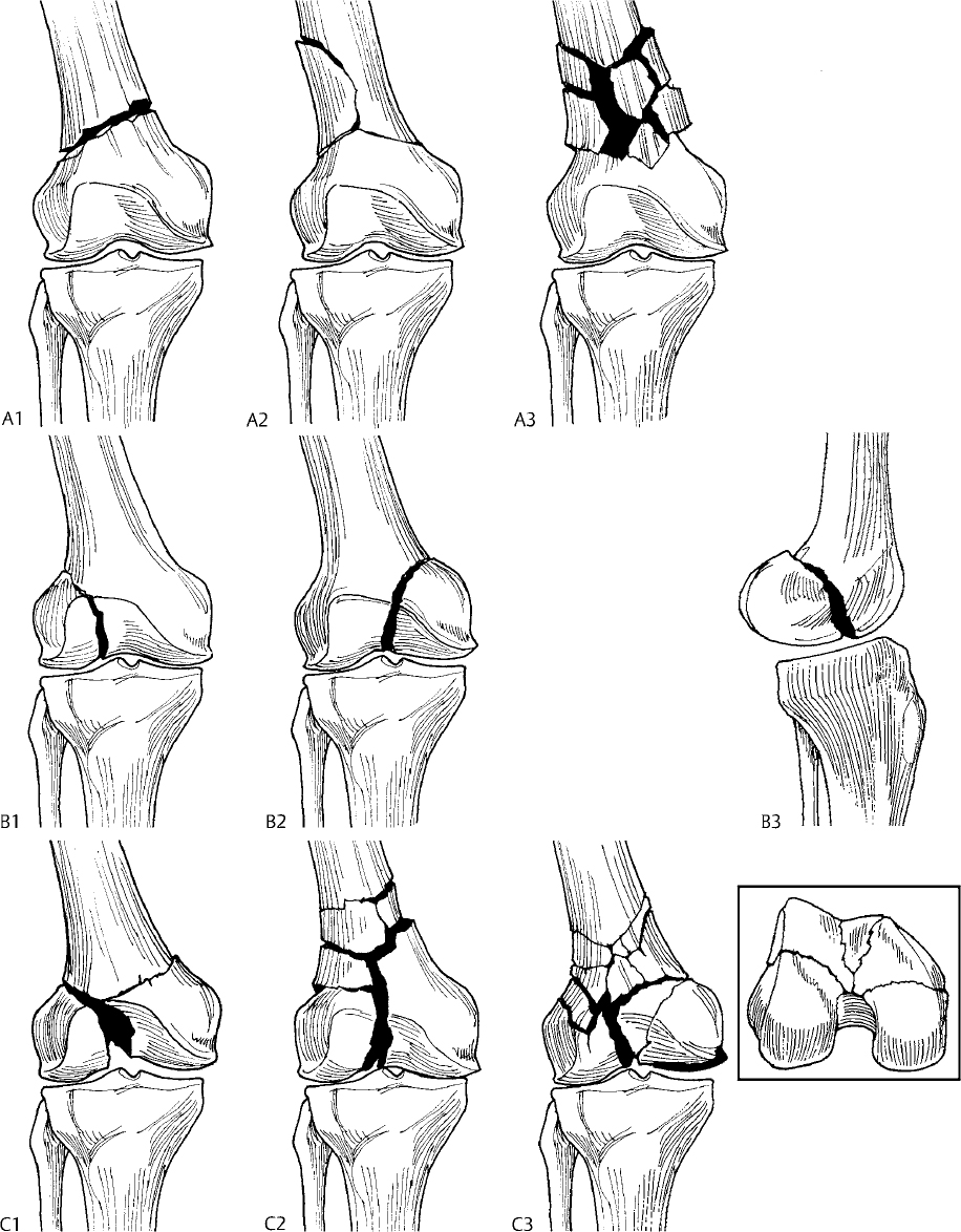 Distal Femur Fractures | Musculoskeletal Key