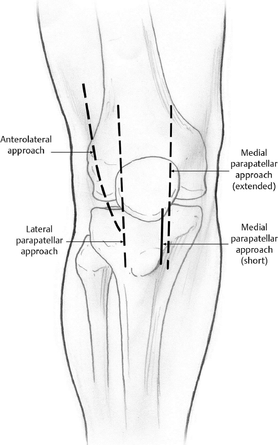 Distal Femur Fractures | Musculoskeletal Key