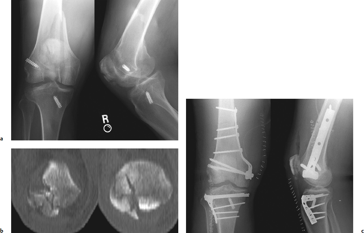 Patella Fractures And Injuries To The Knee Extensor Mechanism ...