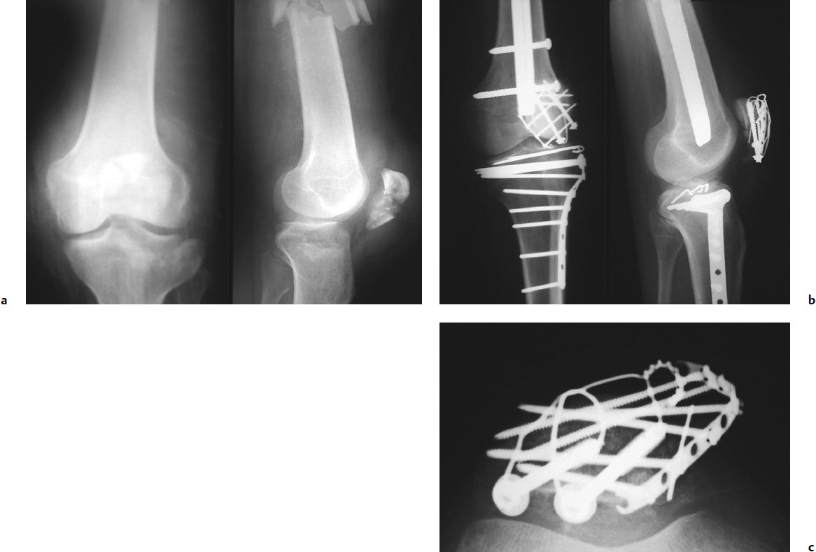 Patella Fractures And Injuries To The Knee Extensor Mechanism ...