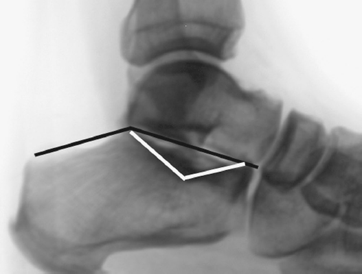 Foot Fractures | Musculoskeletal Key