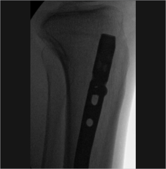 4 Biomechanics Of Internal Fracture Fixation | Musculoskeletal Key