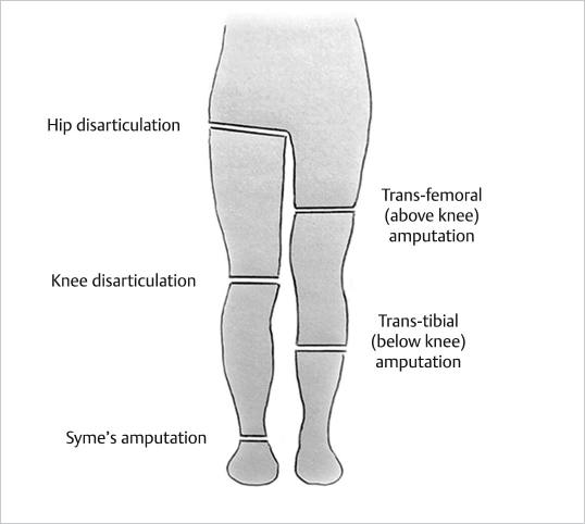 14 Amputations | Musculoskeletal Key