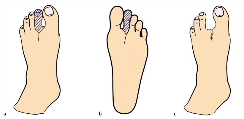 14 Amputations | Musculoskeletal Key