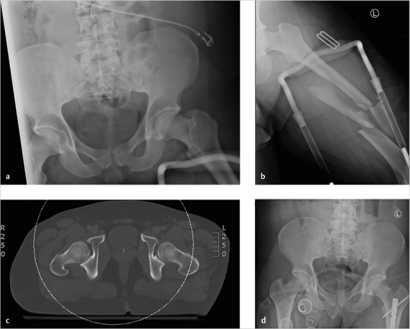 35 Femoral Shaft Fractures | Musculoskeletal Key