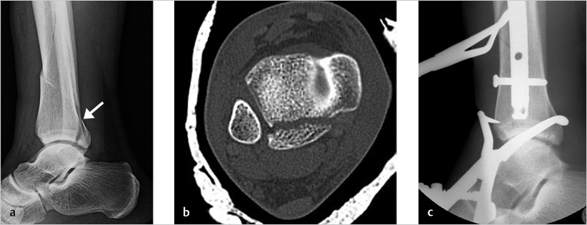 41 Tibia And Fibula Shaft Fractures | Musculoskeletal Key