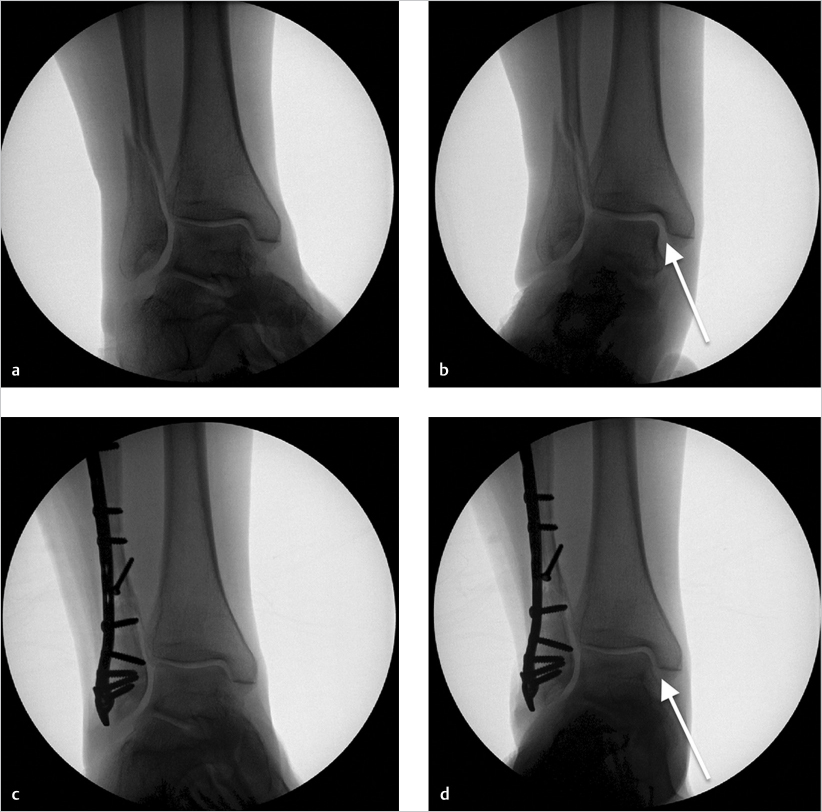 43 Ankle Fractures And Dislocations | Musculoskeletal Key