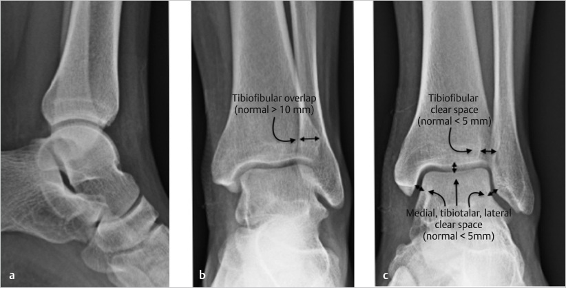 43 Ankle Fractures And Dislocations | Musculoskeletal Key