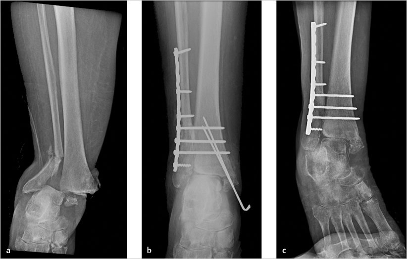 43 Ankle Fractures And Dislocations | Musculoskeletal Key