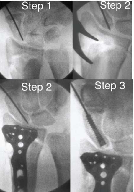 20 Arthroscopic Repair Of Combined Scaphoid And Distal Radius Fractures ...