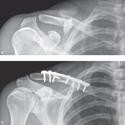 3.2 Clavicular Fractures | Musculoskeletal Key