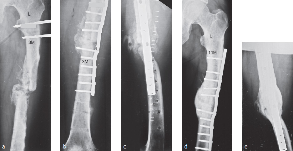 Autogenous Bone Grafting In The Treatment Of Nonunions ...