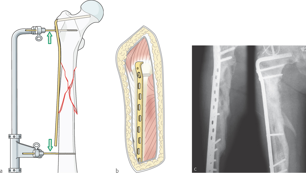 History And Evolution Of Minimally Invasive Plate Osteosynthesis ...