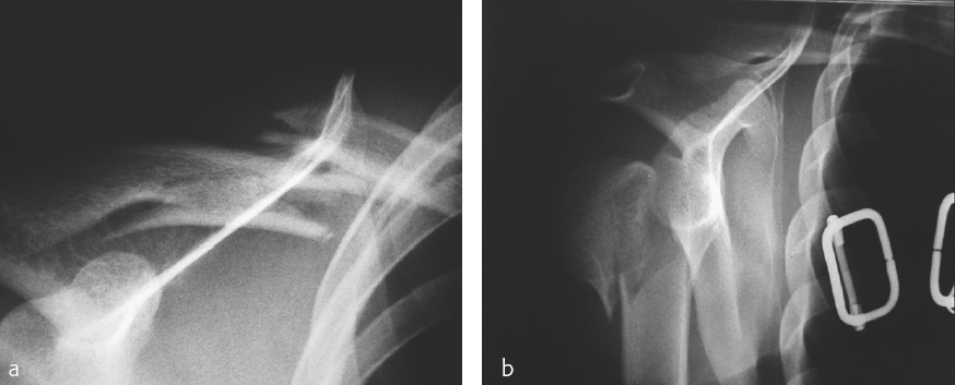 Clavicle, Shaft: Spiral Wedge Fracture—15-B1 | Musculoskeletal Key