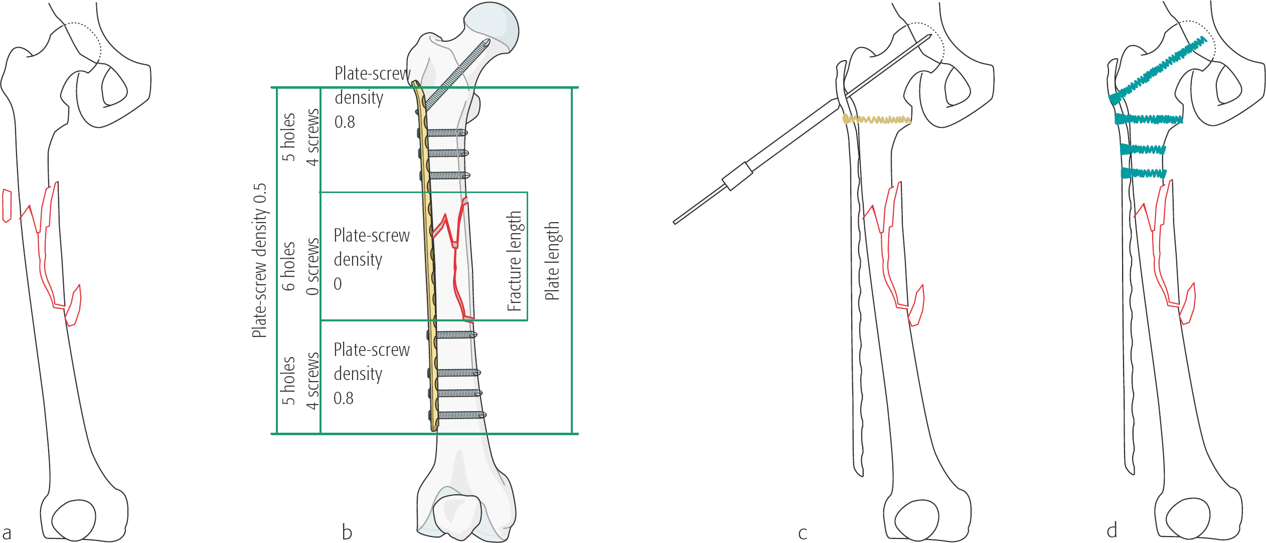 Femur, Shaft: Wedge Fracture, Fragmented Wedge—32-B3 | Musculoskeletal Key