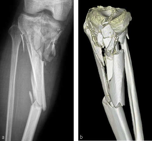 Tibia And Fibula, Proximal—introduction | Musculoskeletal Key