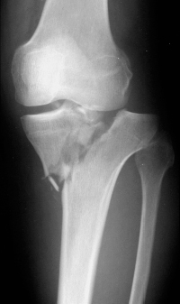 Tibia And Fibula, Proximal—introduction | Musculoskeletal Key