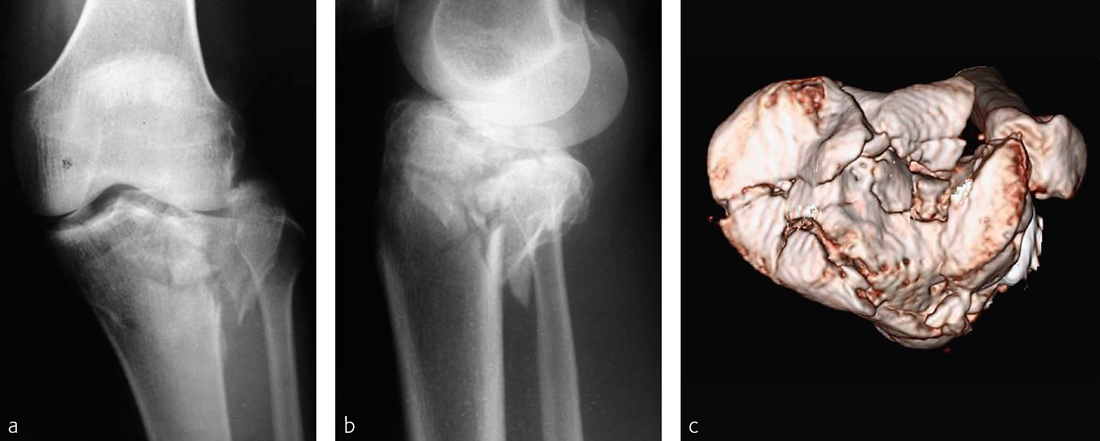 Tibia And Fibula, Proximal—introduction | Musculoskeletal Key