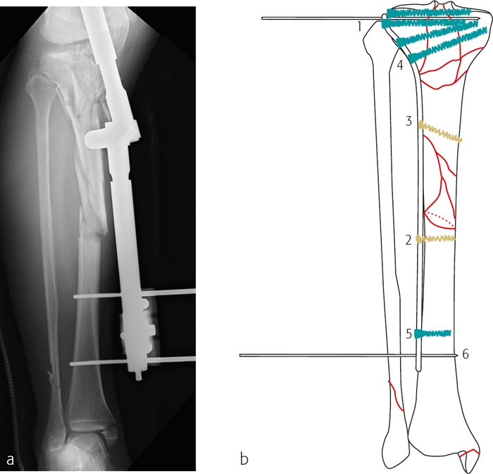 Tibia And Fibula, Proximal: Intraarticular Bicondylar Fracture With A ...