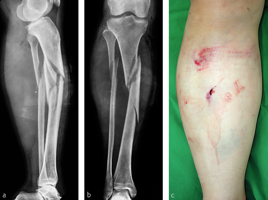 Tibia And Fibula, Shaft: Wedge Fracture, Spiral Wedge—42-B1 ...