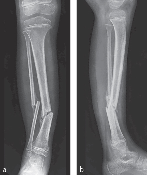 Tibia And Fibula, Shaft: Simple Fracture, Oblique | Musculoskeletal Key