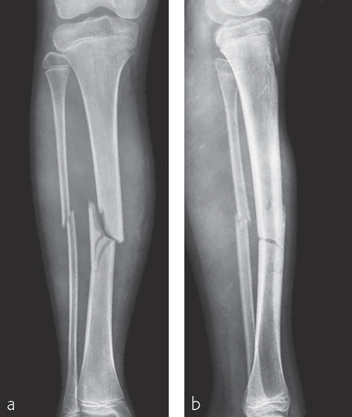 Tibia And Fibula, Shaft: Simple Fracture, Oblique | Musculoskeletal Key