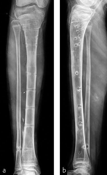 Minimally Invasive Plate Osteosynthesis And Limb Lengthening ...