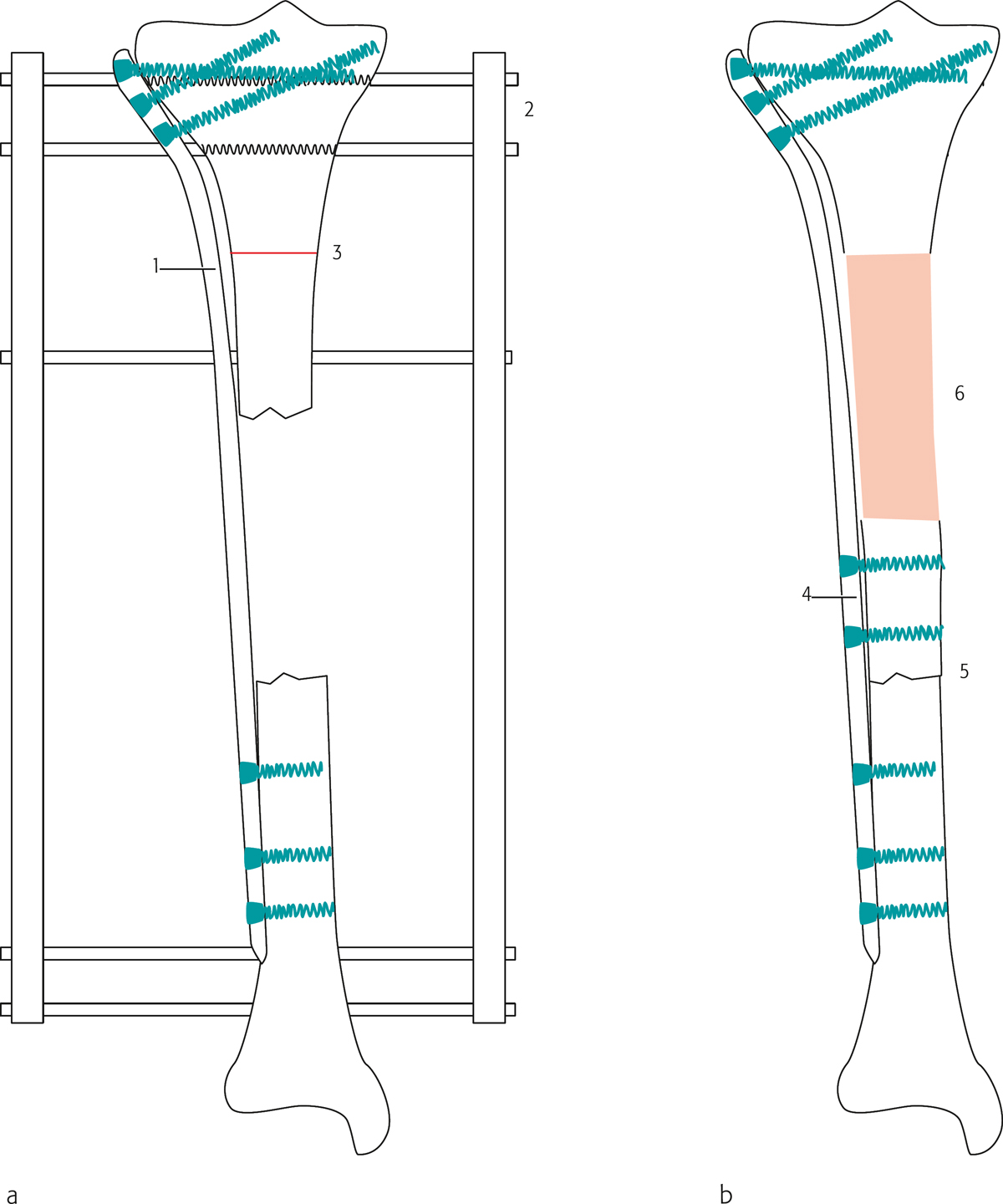 Minimally Invasive Plate Osteosynthesis And Bone Transport For ...