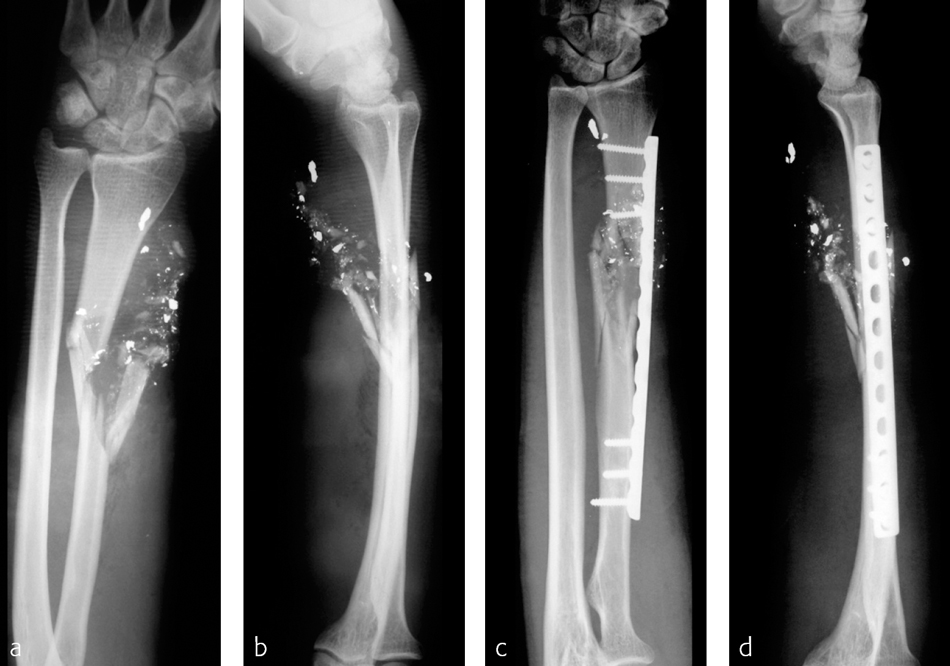 Minimally Invasive Plate Osteosynthesis Of Diaphyseal Forearm Fractures ...