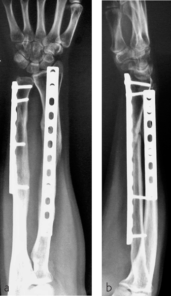 Minimally Invasive Plate Osteosynthesis Of Diaphyseal Forearm Fractures ...