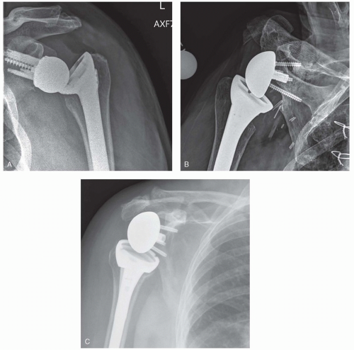 Shoulder Arthritis And Arthroplasty | Musculoskeletal Key