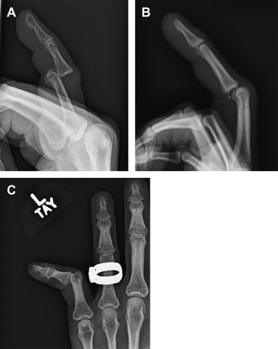 Management Of Finger Joint Dislocation And Fracture-Dislocations In ...