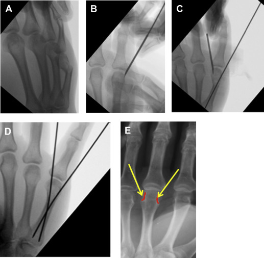 Management Of Metacarpal And Phalangeal Fractures In The Athlete ...