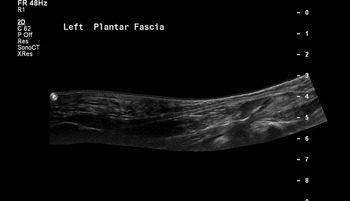 Chapter 14 – Heel Pain | Musculoskeletal Key