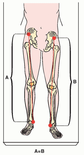 Leg Length Discrepancy | Musculoskeletal Key