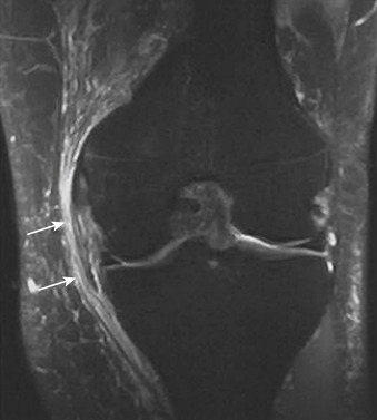 Medial Collateral Ligament | Musculoskeletal Key