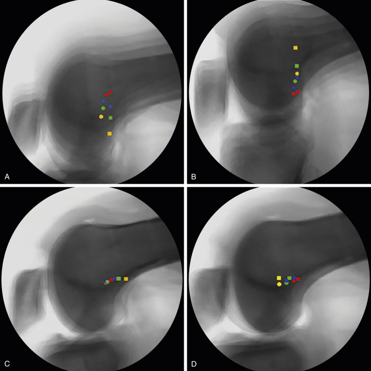 Patellar Instability | Musculoskeletal Key