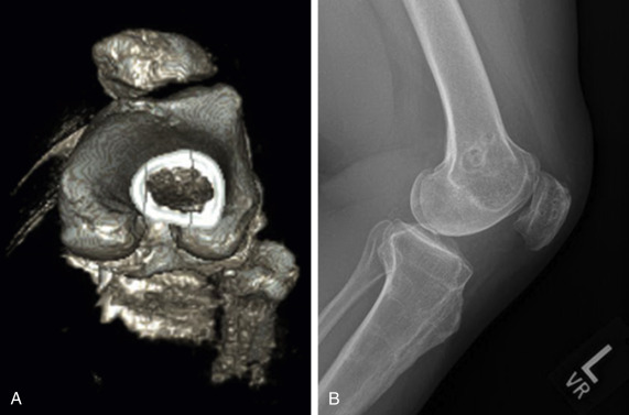 Patellar Instability | Musculoskeletal Key