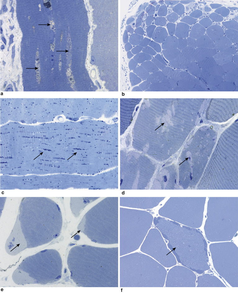 The Procedure Of Muscle Biopsy | Musculoskeletal Key